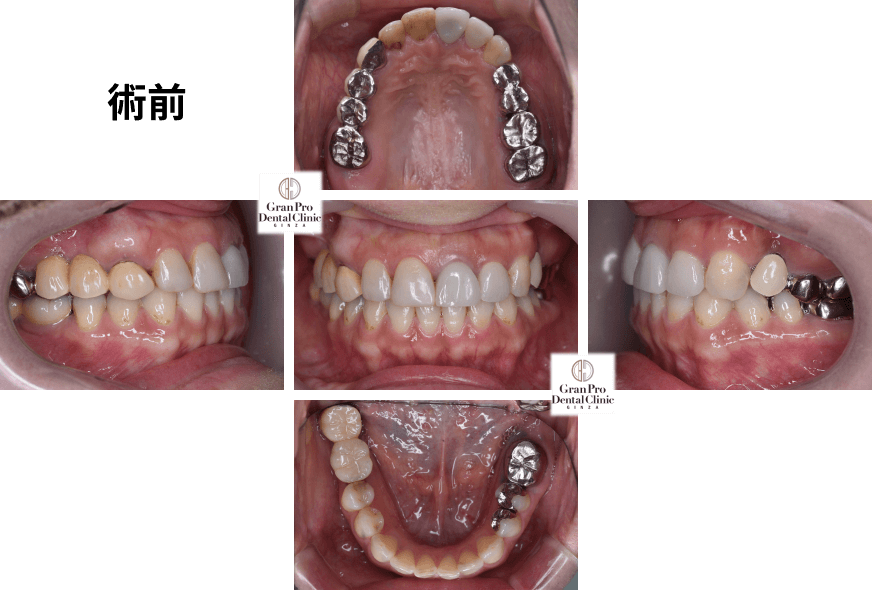 噛み合わせ症例