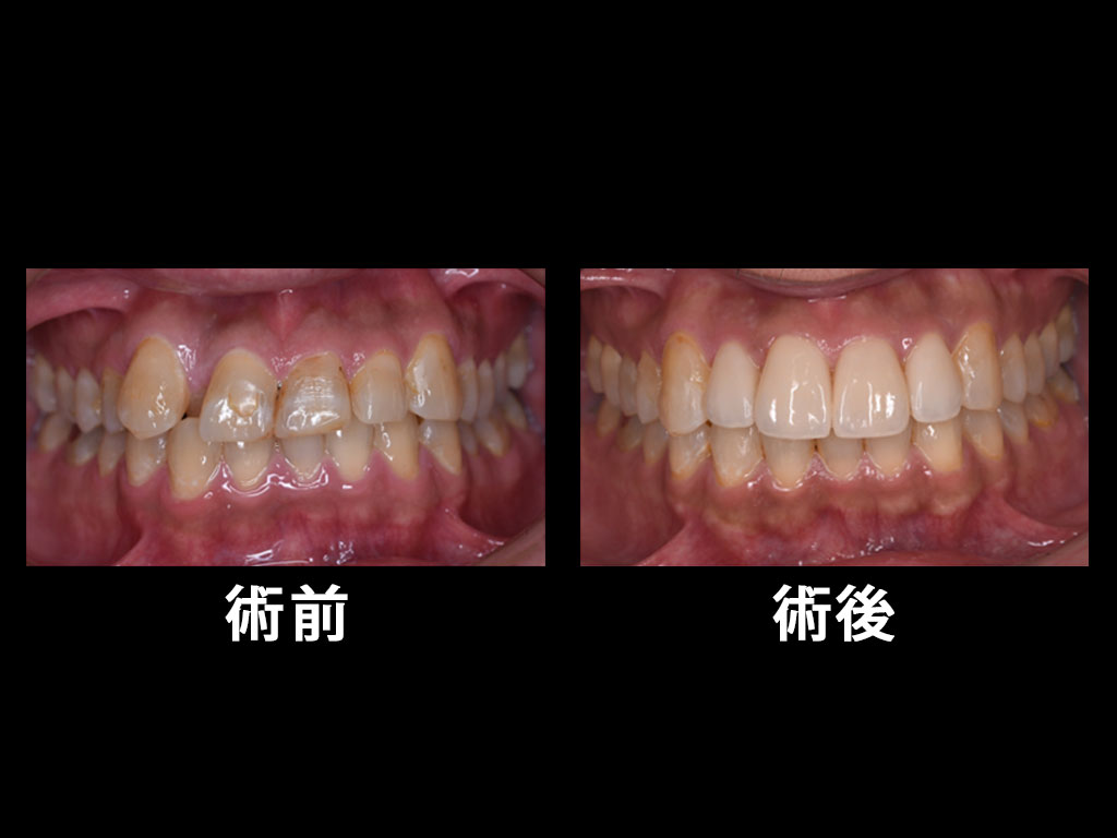 前歯の審美的な治療を希望された方