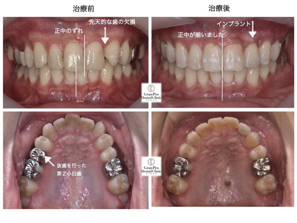 永久歯の先天的欠如（生まれつき歯が生えてこない）の方の症例