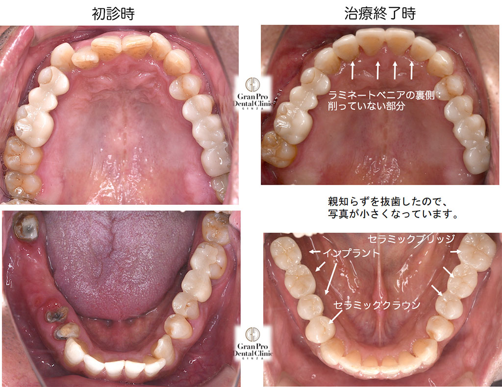 受け口の治療